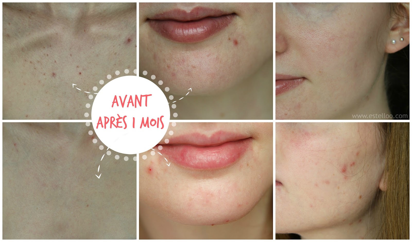 Roaccutane quelle pilule