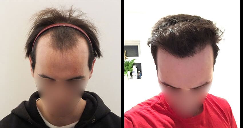 Finasteride moins cher