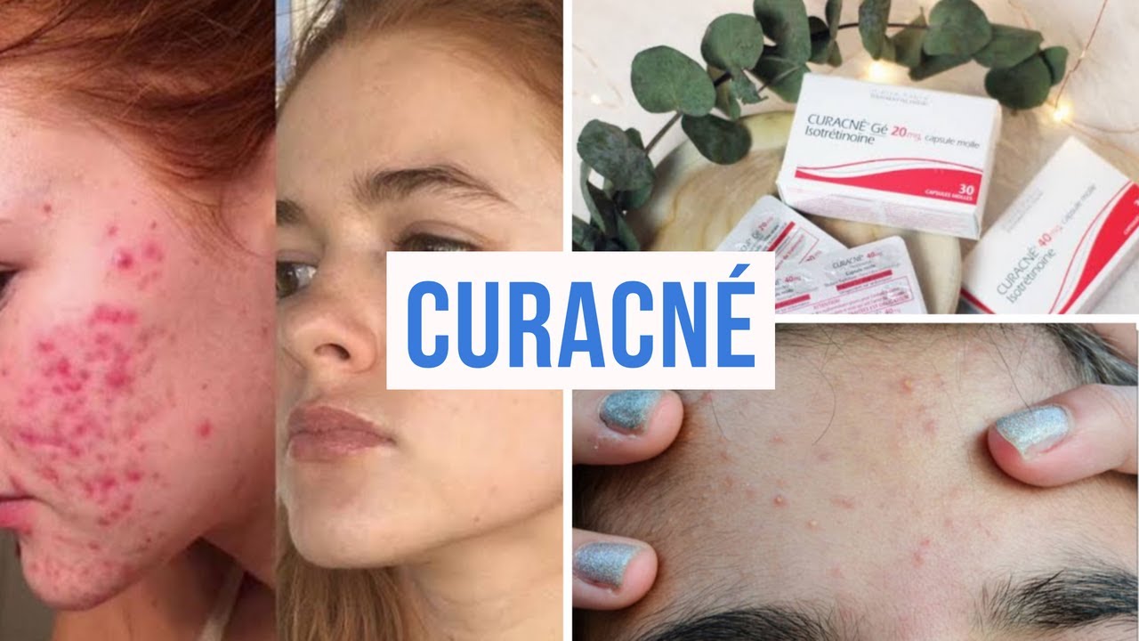 Roaccutane France Prix