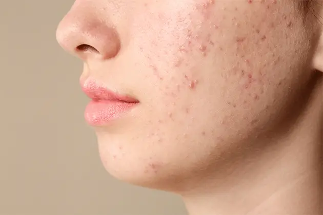Où Acheter Du Accutane
