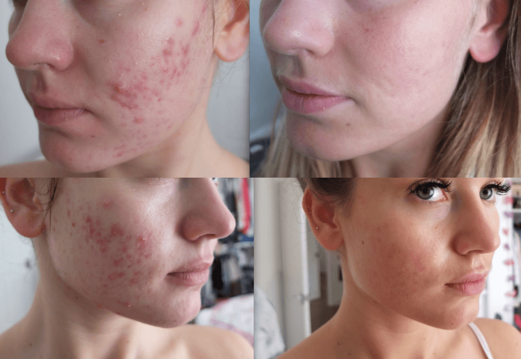 commander du roaccutane