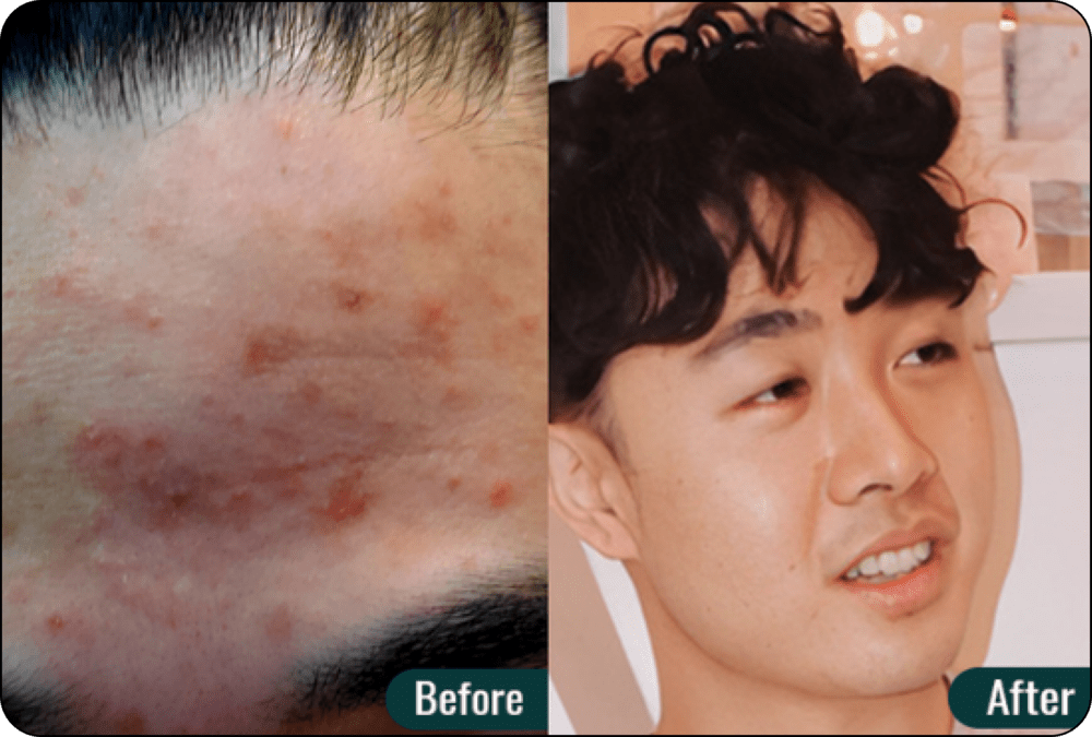 Accutane 40mg online