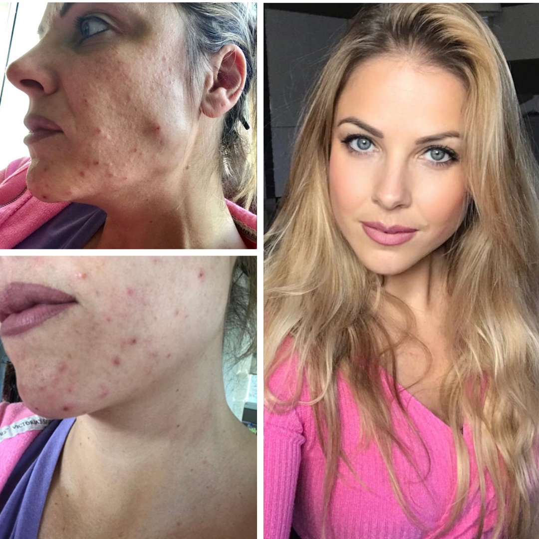 Roaccutane apres arret pilule