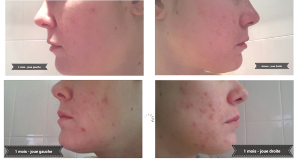 Roaccutane 5mg