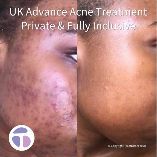 Coût Isotretinoin
