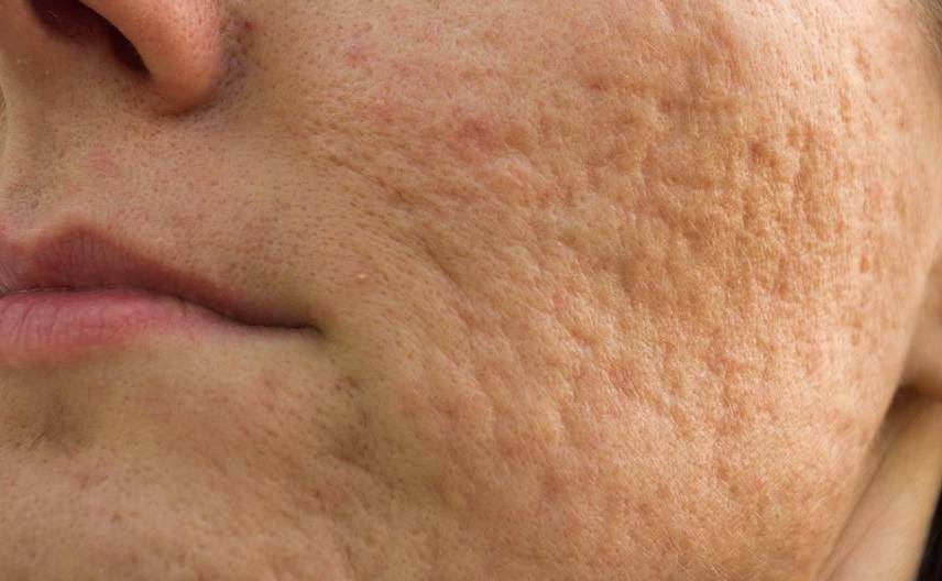 Online dermatologist isotretinoin