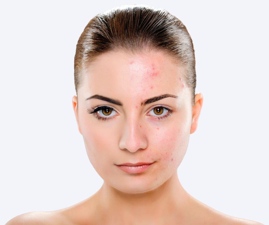 Roaccutane Pommade Prix