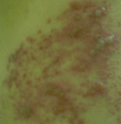 Valacyclovir achat