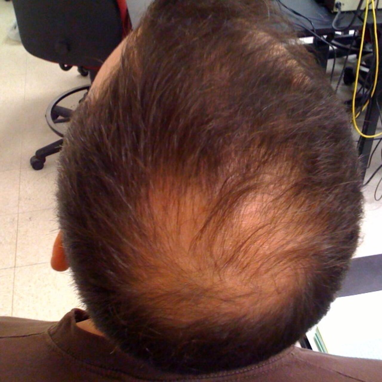 Finasteride in france