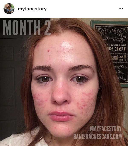 Ordre roaccutane