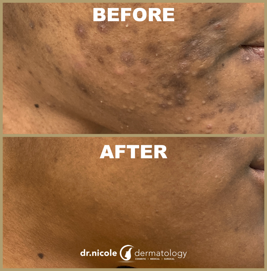 Online dermatologist isotretinoin