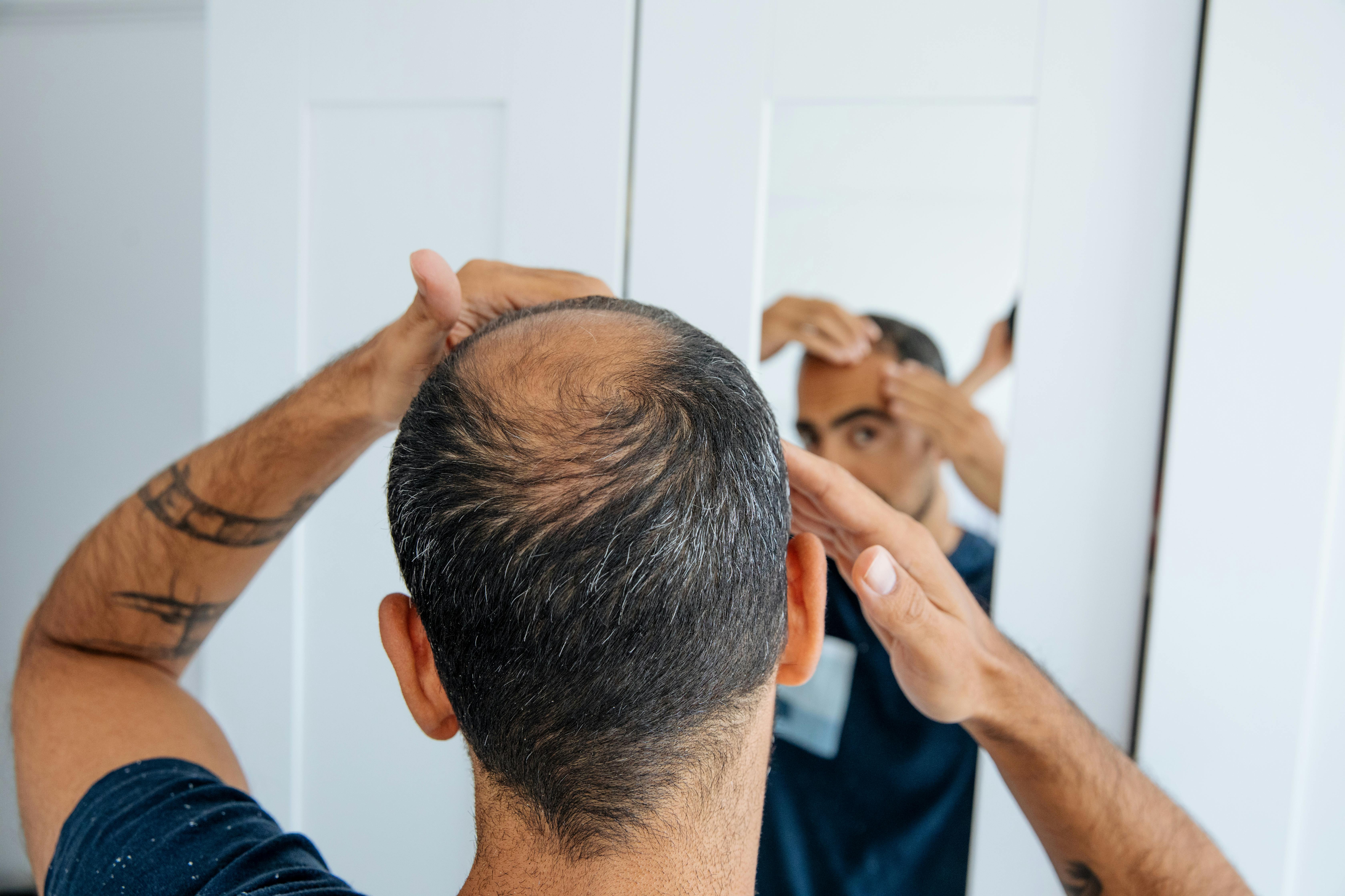 Finasteride 5 mg generique