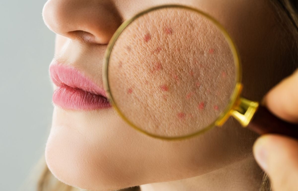 Accutane Achat