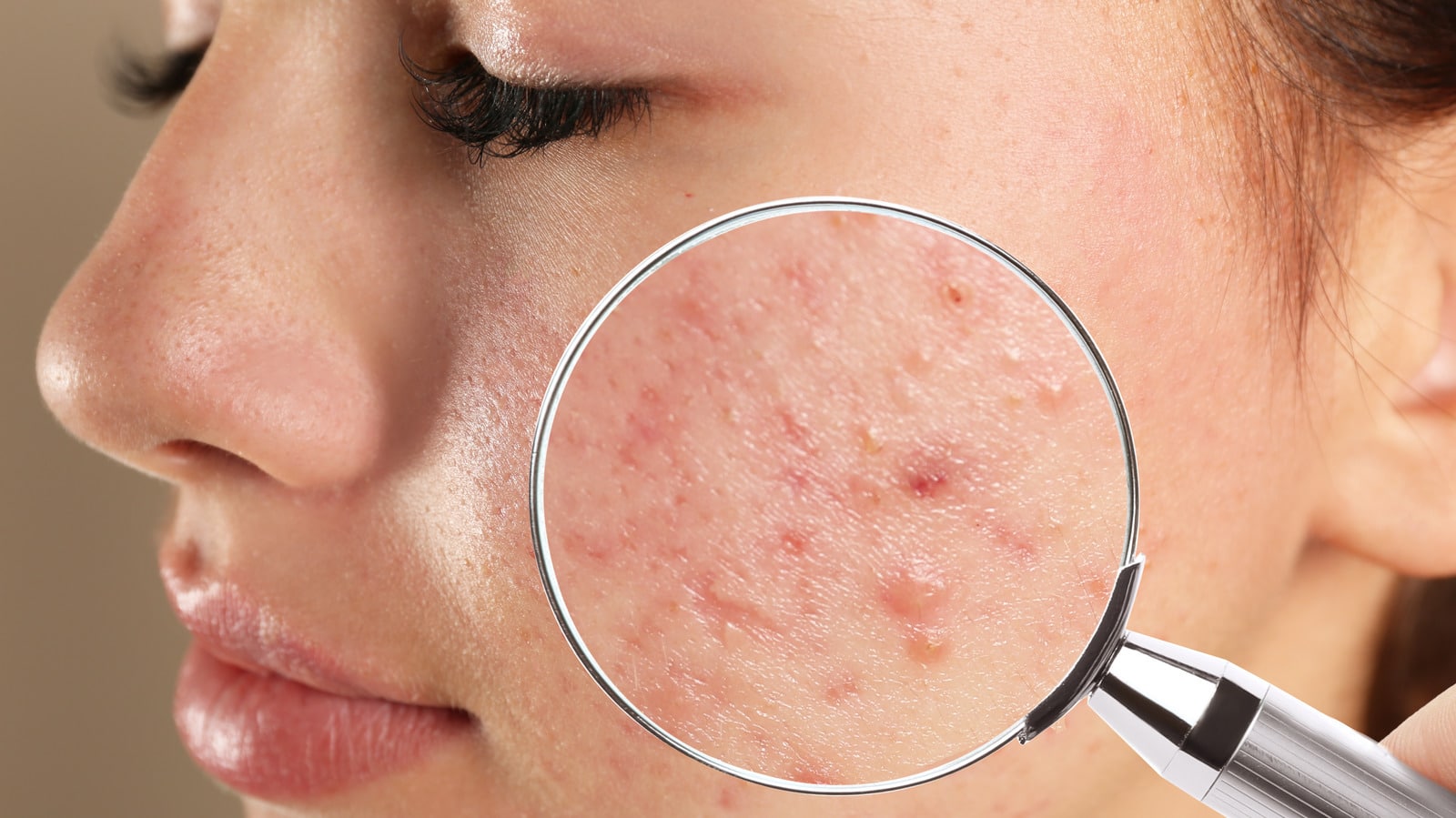 Accutane achat