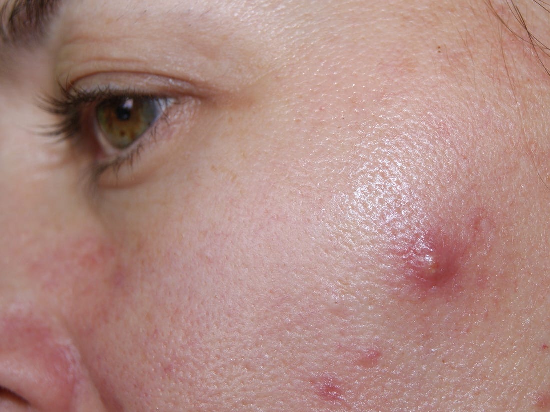 Accutane france