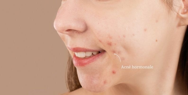 Accutane france