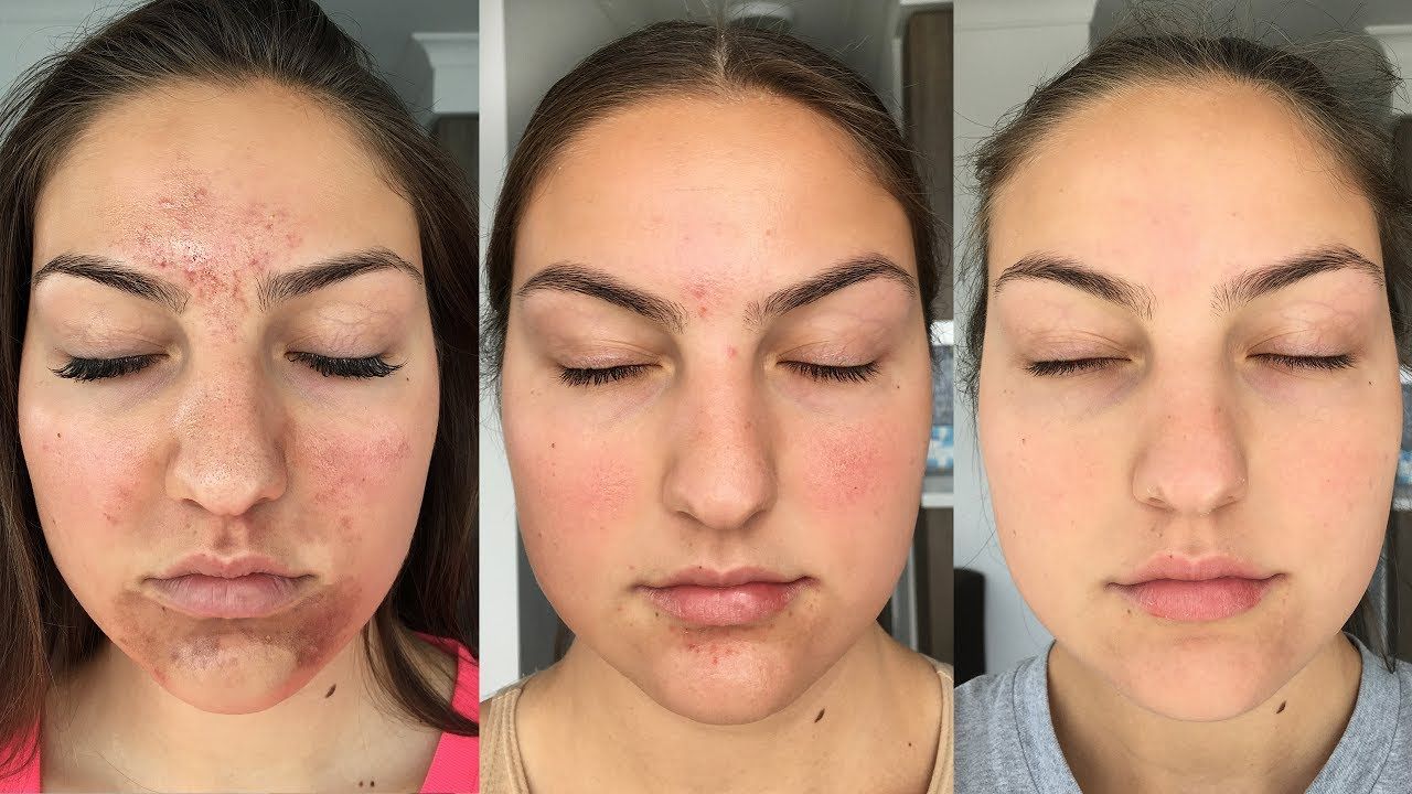 accutane france