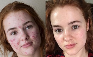 Accutane france acheter