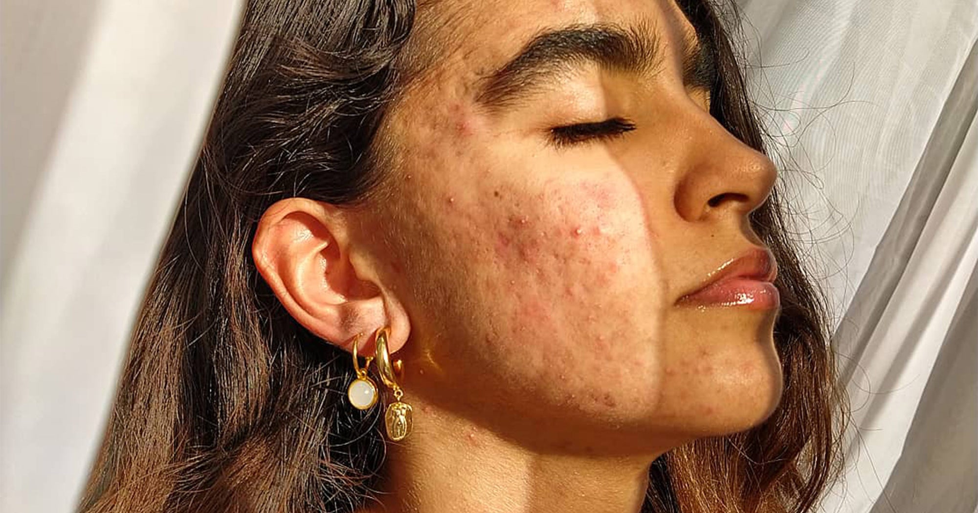 Accutane france acheter