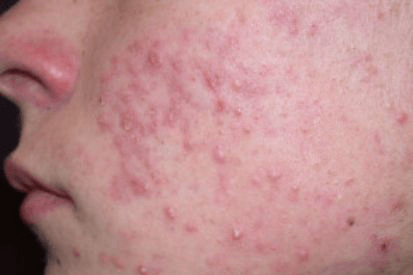 accutane online