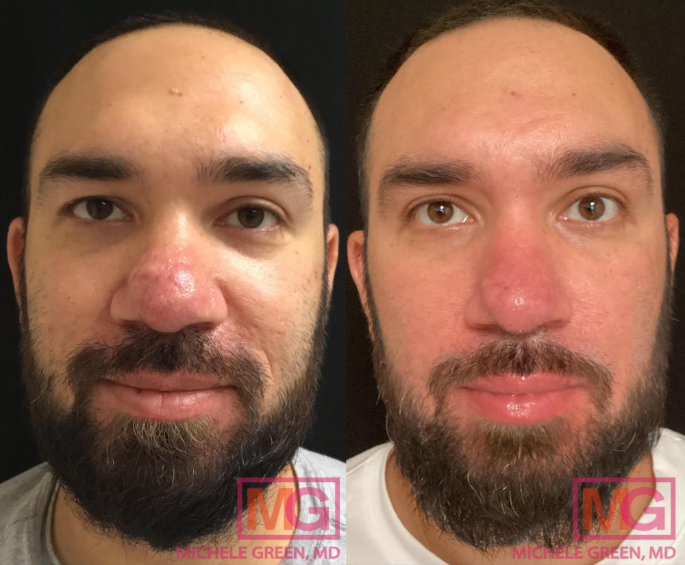Accutane online
