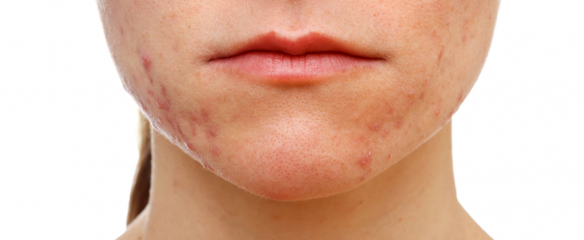 Accutane online acheter