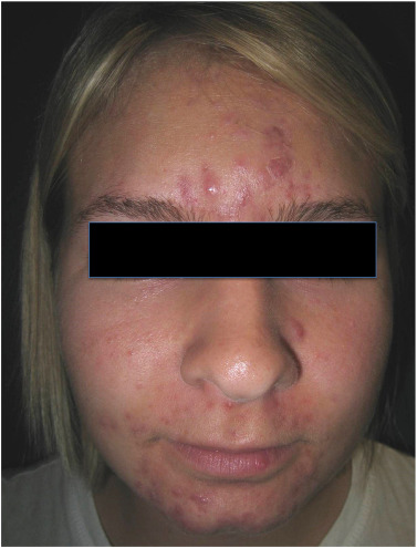 Accutane Online Italia