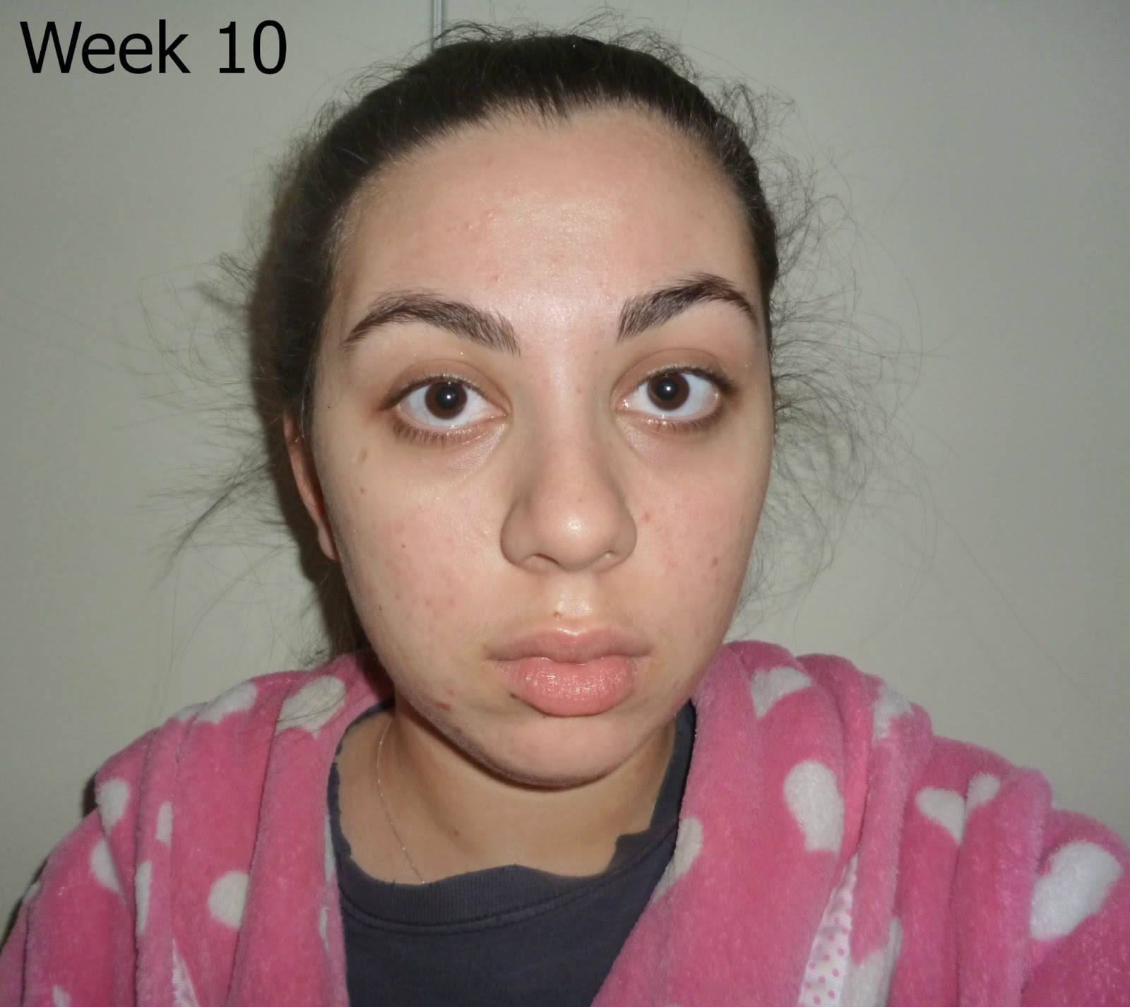 Accutane online italia