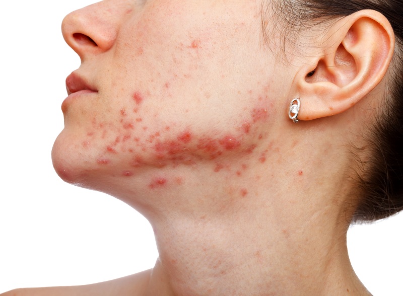 Accutane Pilules