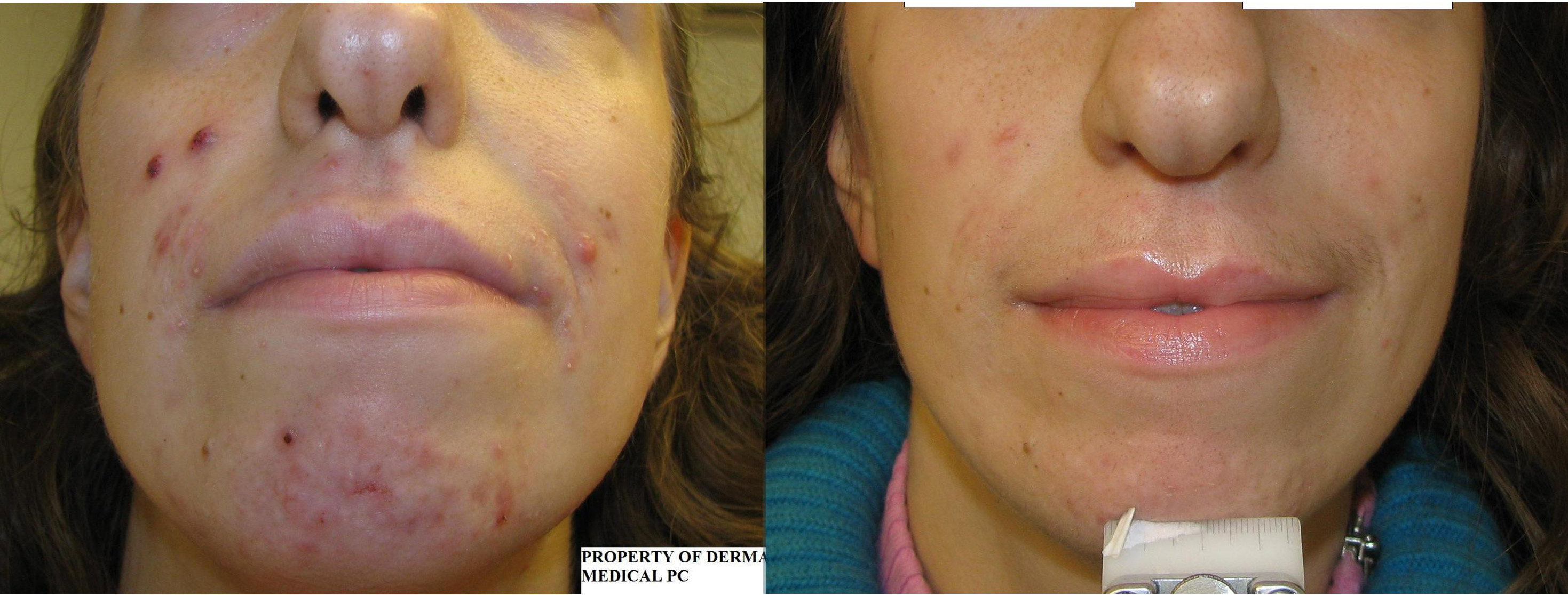 Accutane prix france