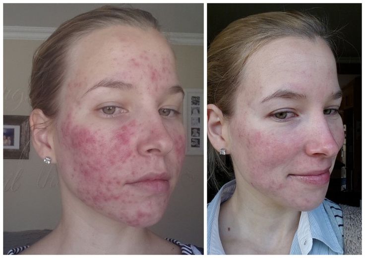 Accutane Prix France