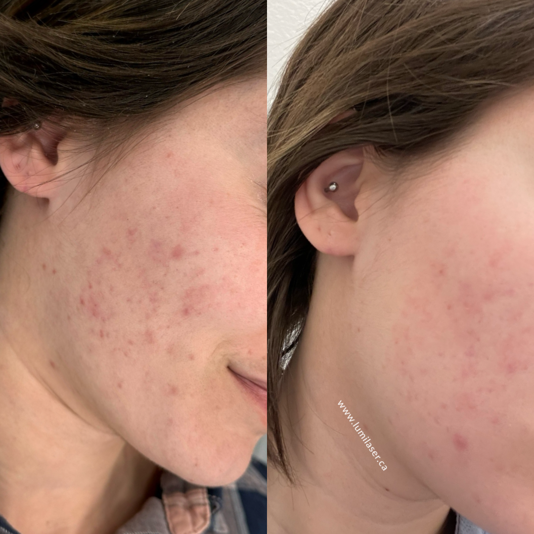 Accutane Prix Québec