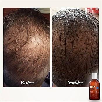 Achat finasteride en ligne
