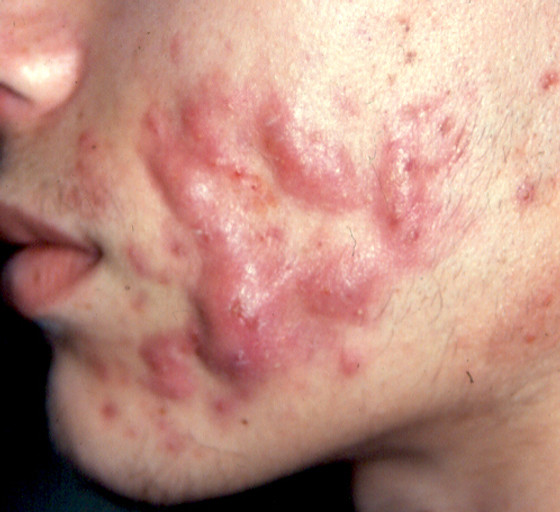 Achat roaccutane en ligne
