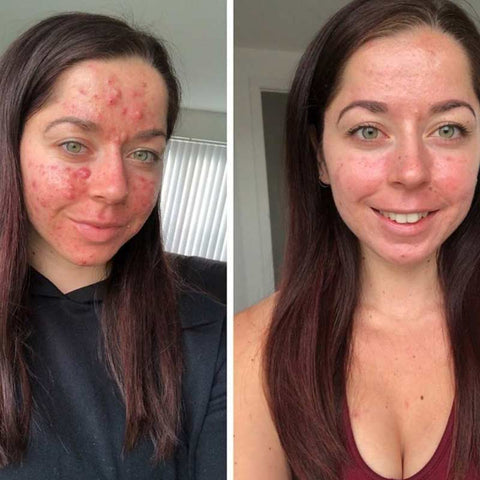 acheter accutane