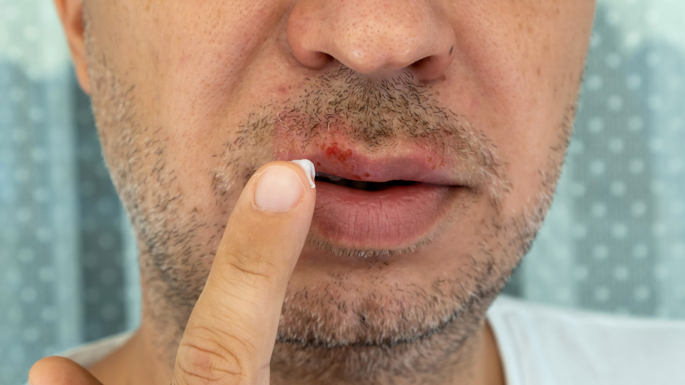 acyclovir over the counter france