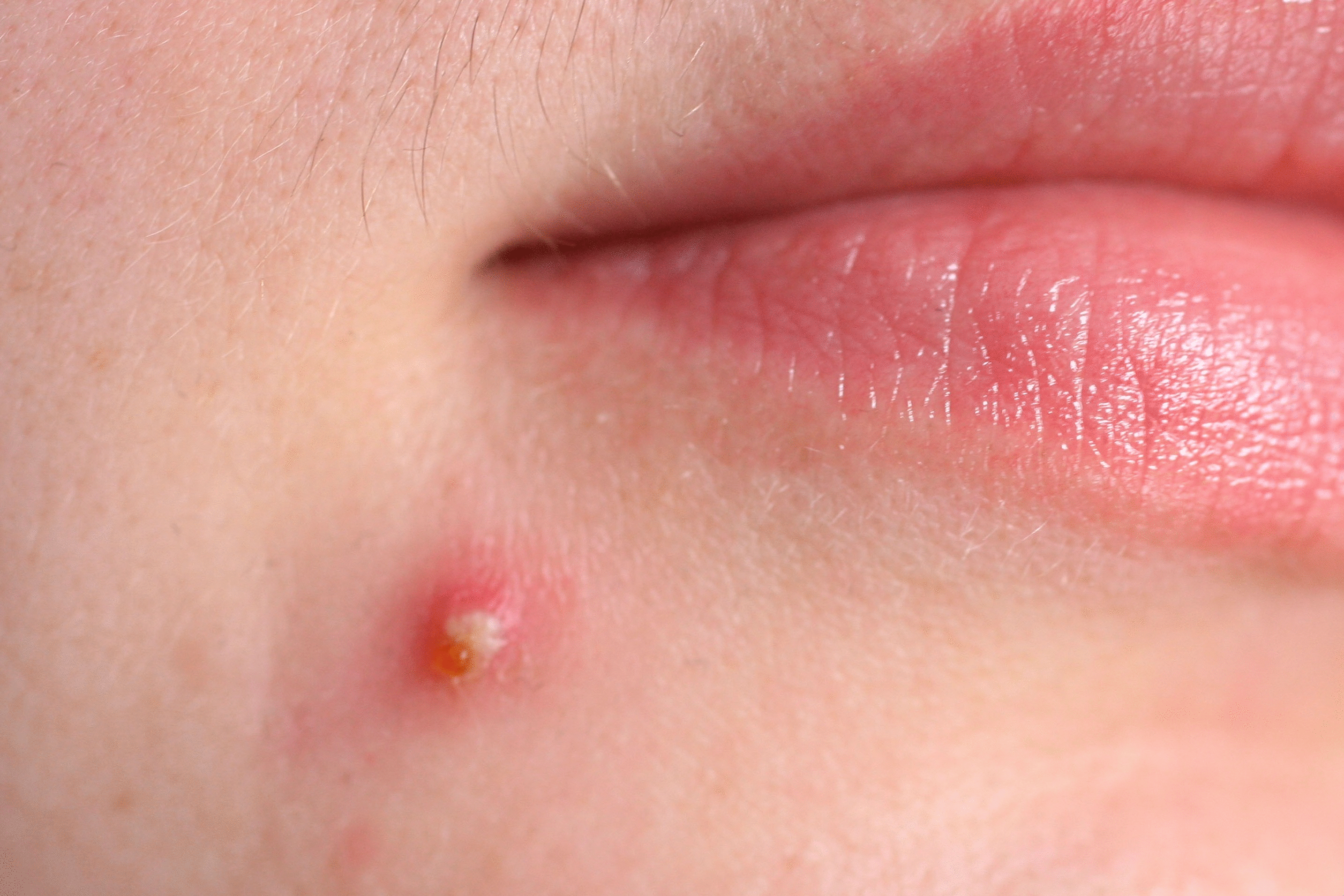 Online dermatologist accutane