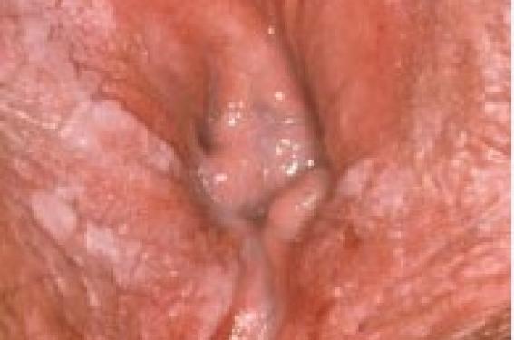 Aldara en ligne