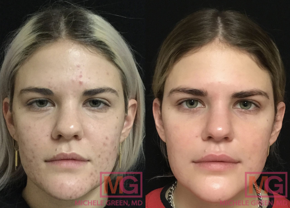 Isotretinoin france