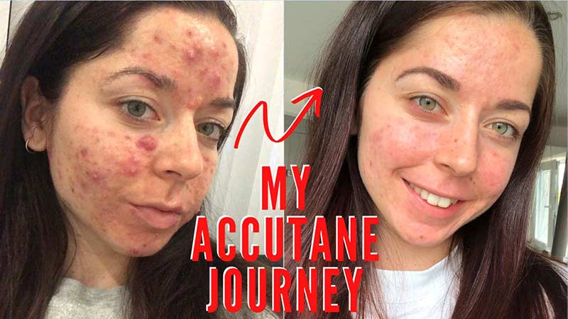 Acheter accutane