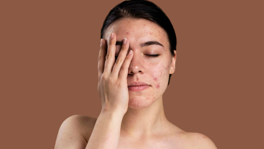 Commander Accutane En Ligne