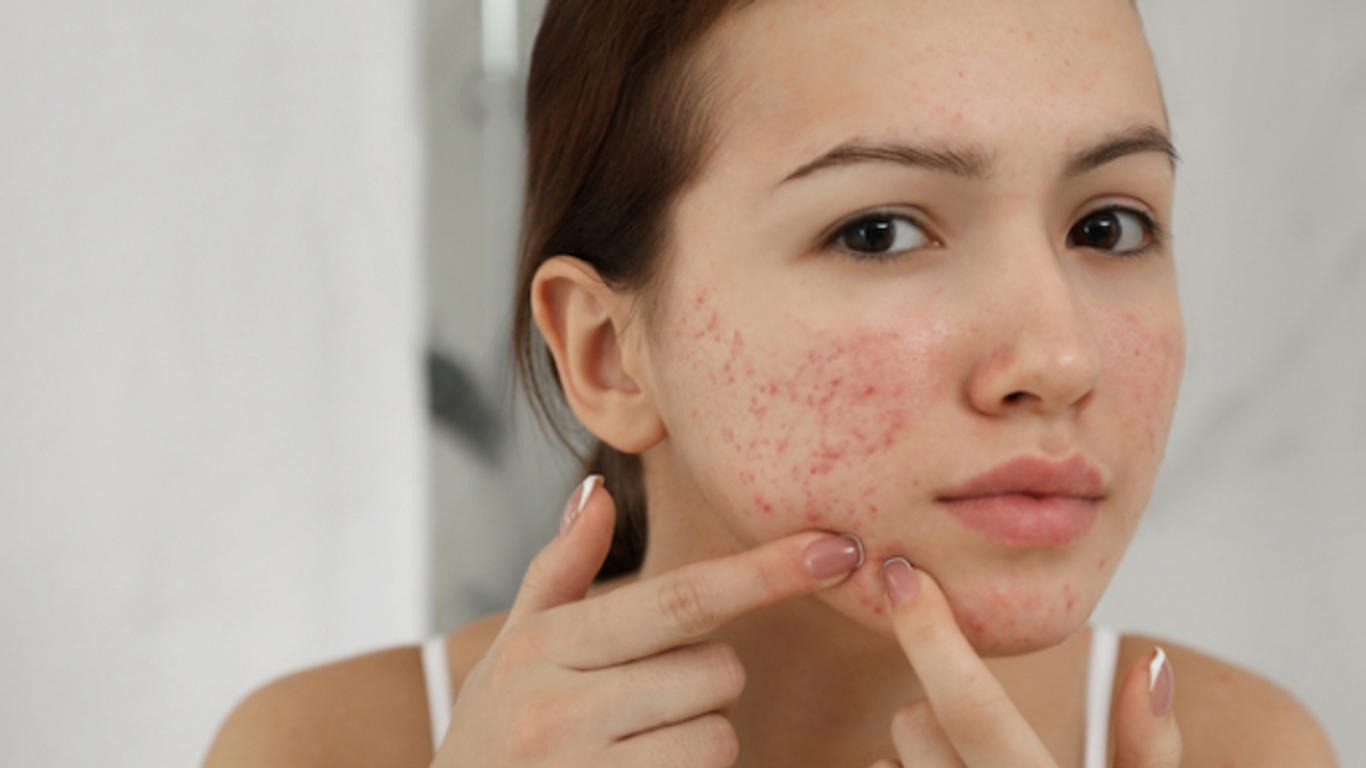 Coût roaccutane