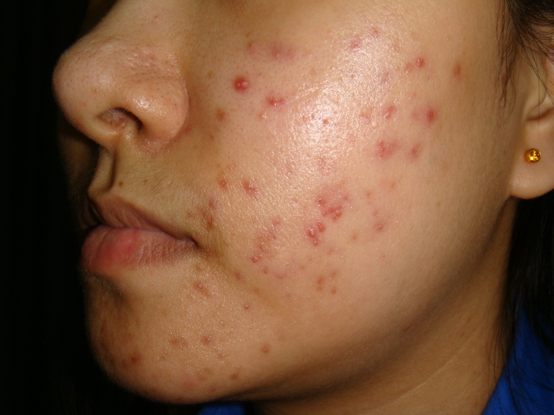 Roaccutane online