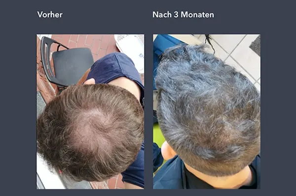 Finasteride Mylan Prix