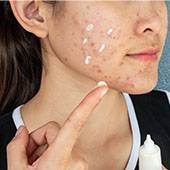 accutane comment acheter