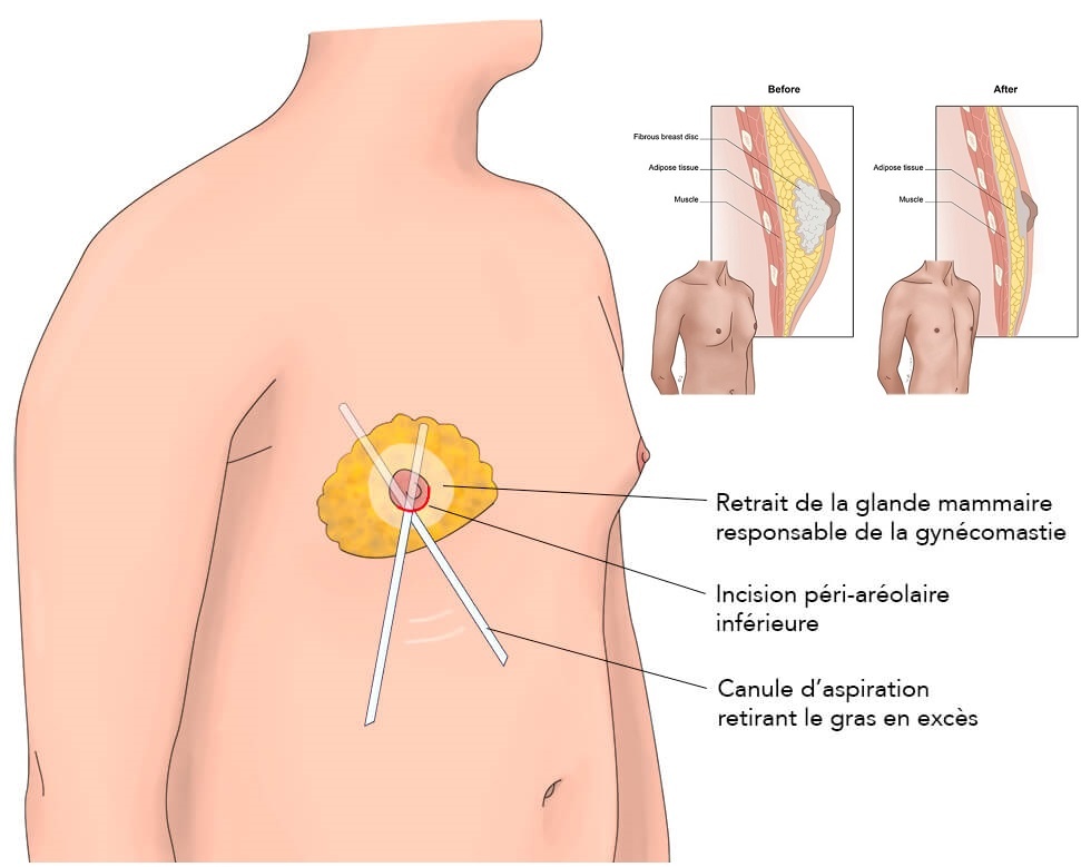 Tamoxifène pas cher