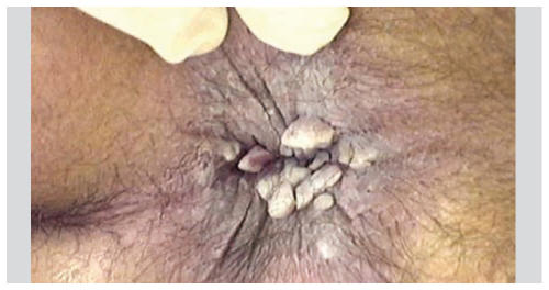Imiquimod Online