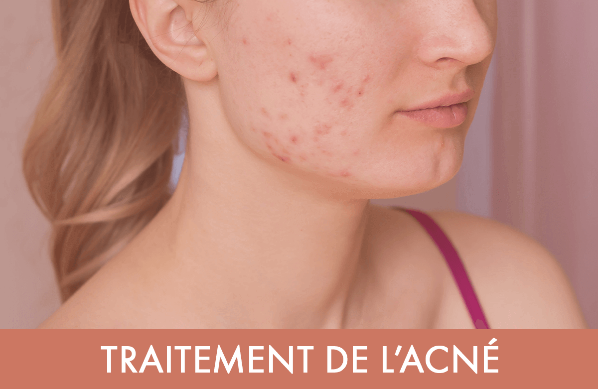 Prix de roaccutane