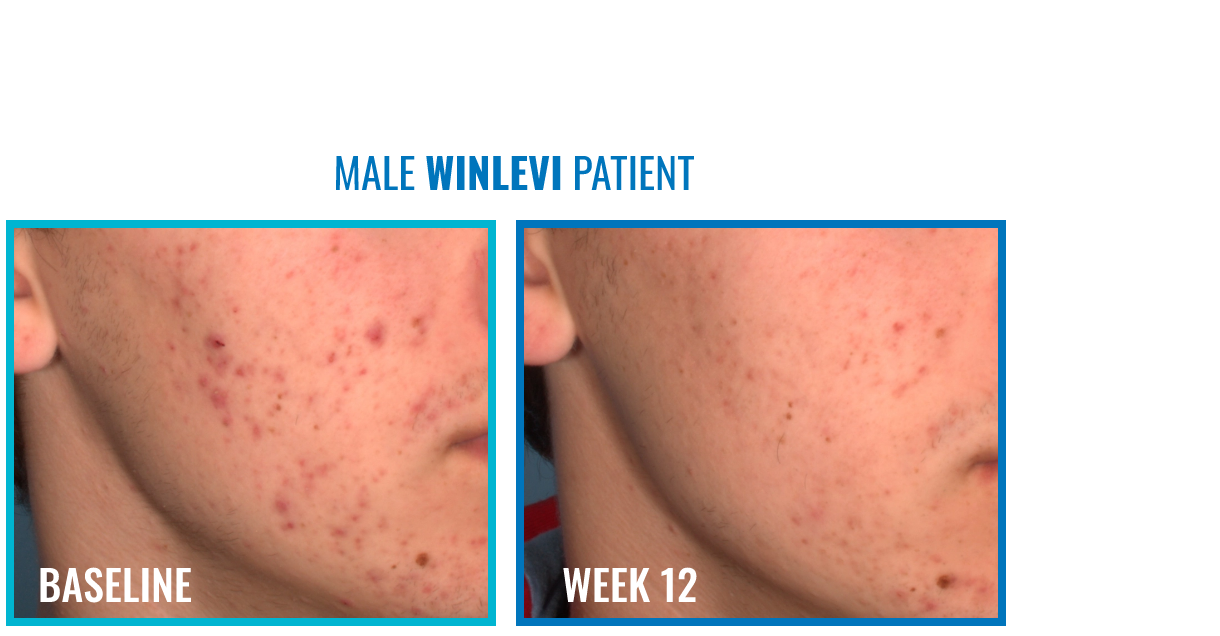 Commander accutane ligne