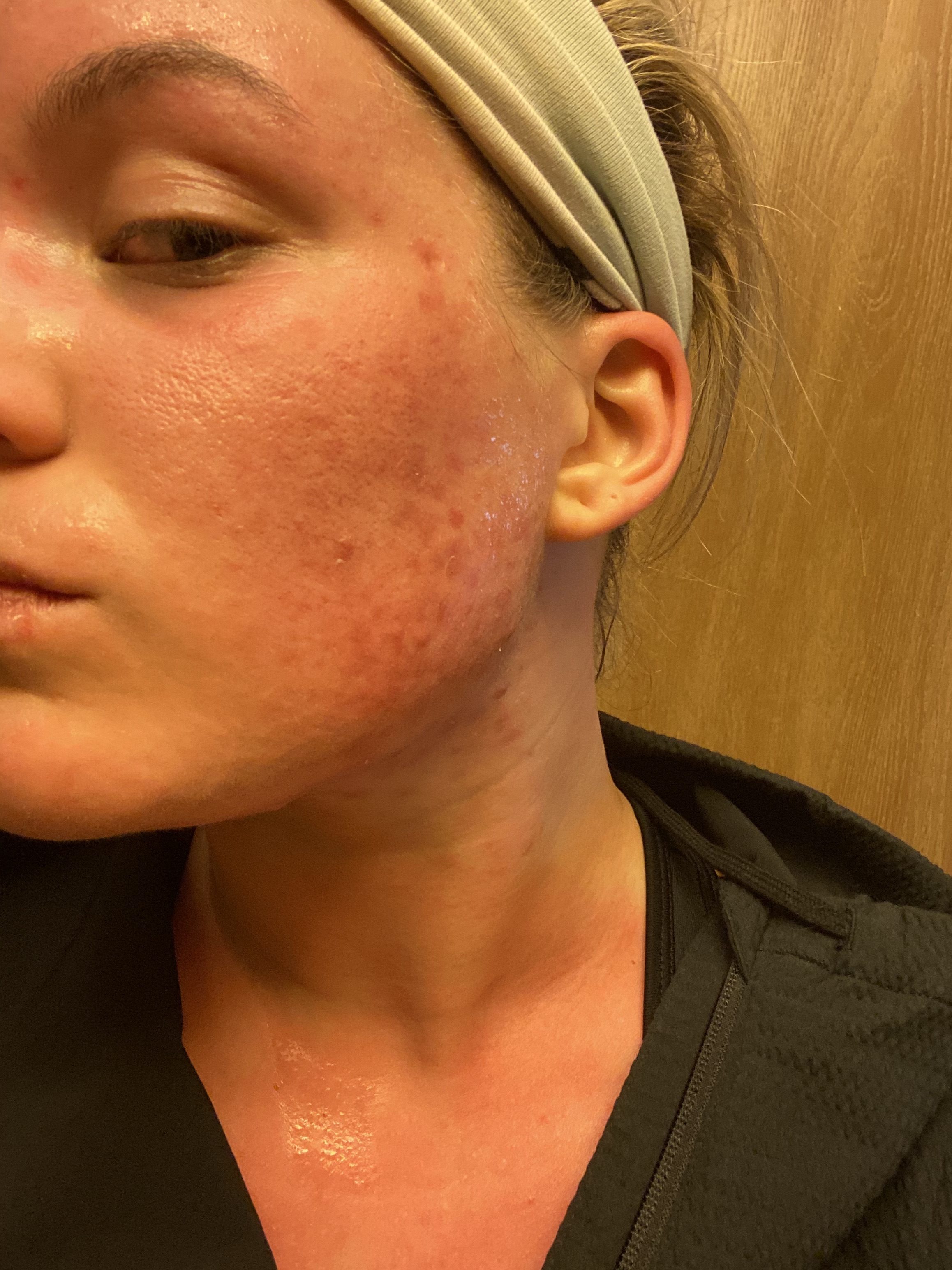 Commander du accutane